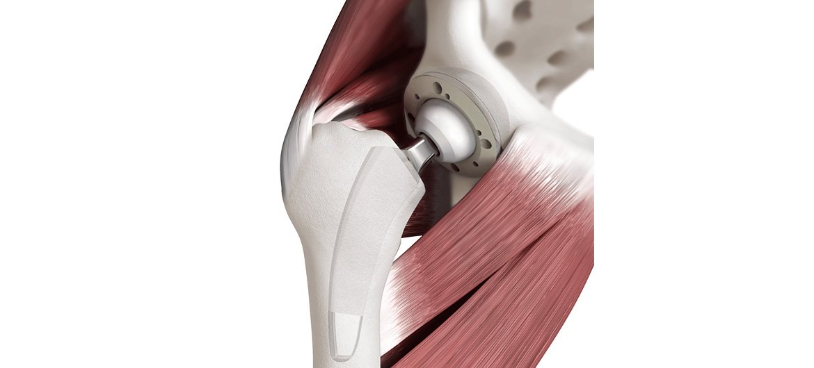 Halbseitige (unikondyläre oder Teil-) Prothese