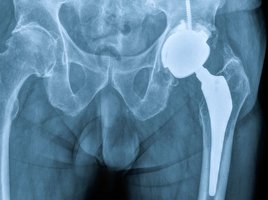 Revisionsendoprothetik