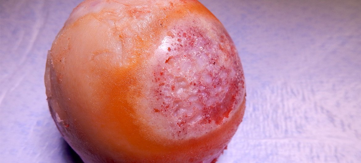 Halbseitige (unikondyläre oder Teil-) Prothese