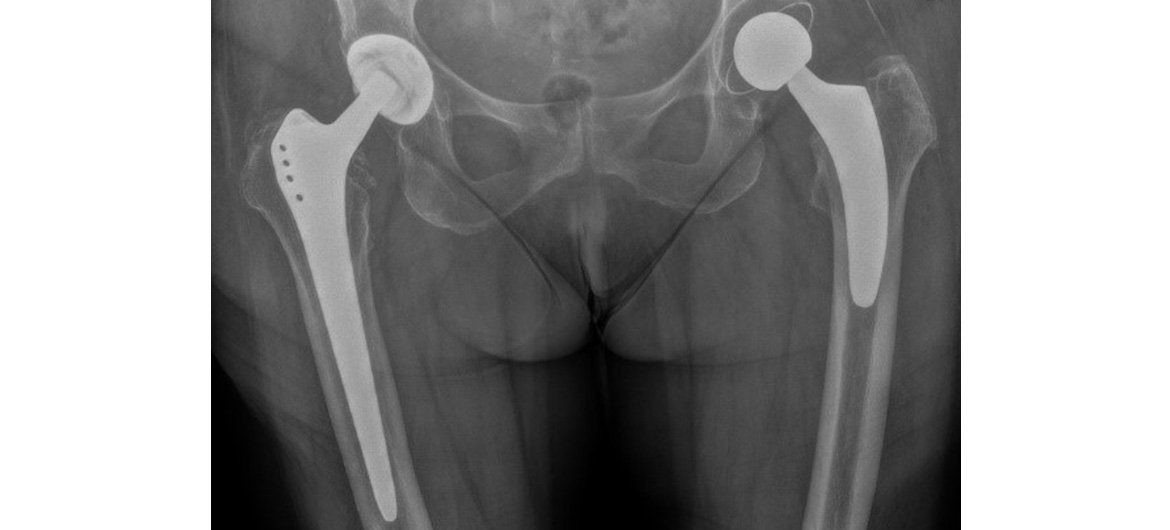 Halbseitige (unikondyläre oder Teil-) Prothese