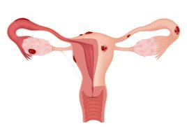 Endometriose