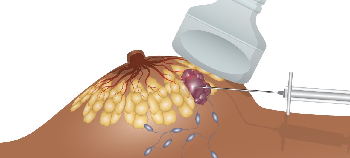 Halbseitige (unikondyläre oder Teil-) Prothese